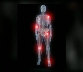 All About Remedies for Gout