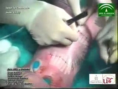 Ciencia / Salud:Separan a dos siamesas unidas por el abdomen