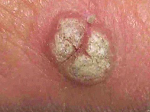 Foot Warts Treatment - Podiatrist in Frederick, Germantown and Hagerstown, MD