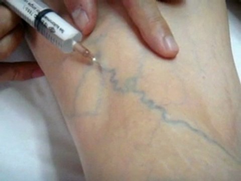 Opr.Dr.Cafer Abbasoğlu ile Selülit Tedavisi