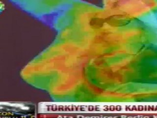 Meme Silikonu Kanser Yapar mı? - Prof Dr Ahmet Karacalar- Show  Ana Haber