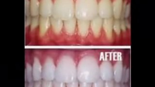 Secret To Teeth Whitening Exposed