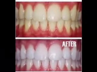 Secret To Teeth Whitening Exposed