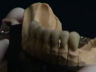 Les différents types de prothèse dentaire