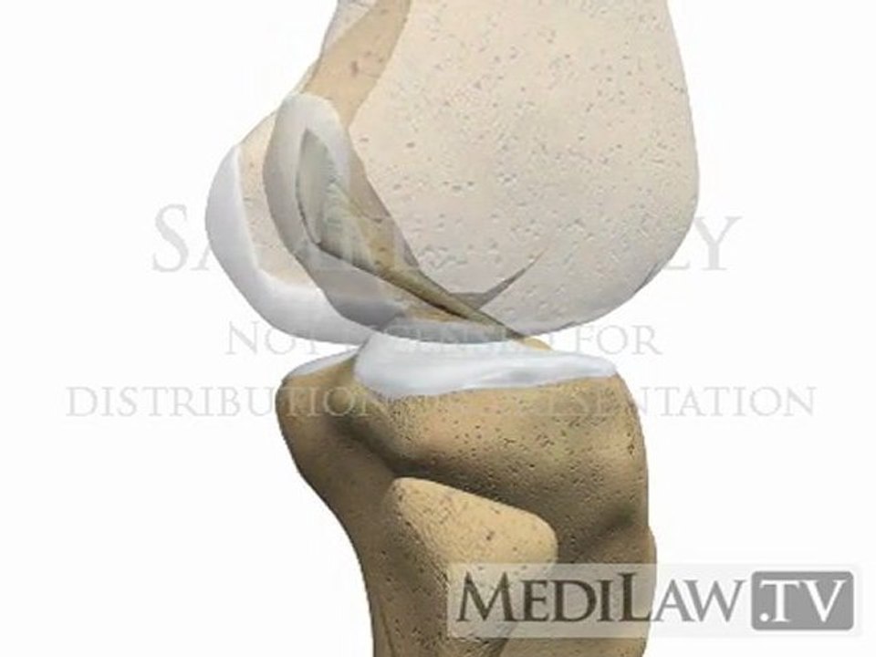 Knee Anterior Cruciate Ligament Anatomy surgical artwork