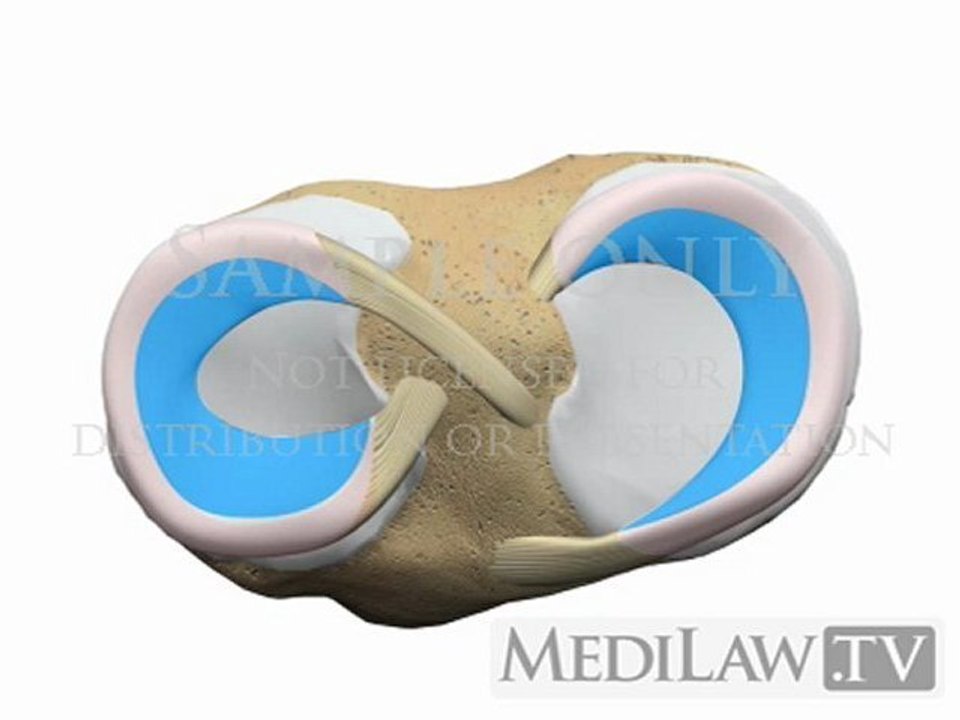 Knee Meniscal Meniscus Flap, Oblique, Parrot Beak Tear patient education software