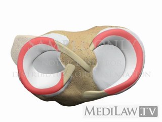 Knee Meniscal Meniscus Degenerate Horizontal Cleavage Tear orthopaedic surgery graphics