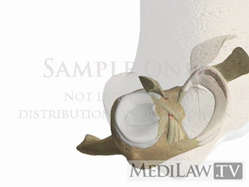 Knee Anterior Cruciate Ligament Rupture Internal Femoral Rotation orthopeadic images