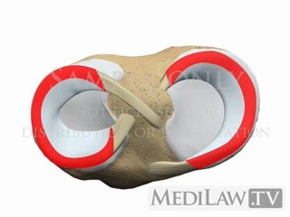 Knee Meniscal Vertical Longitudinal Tear orthopedic images