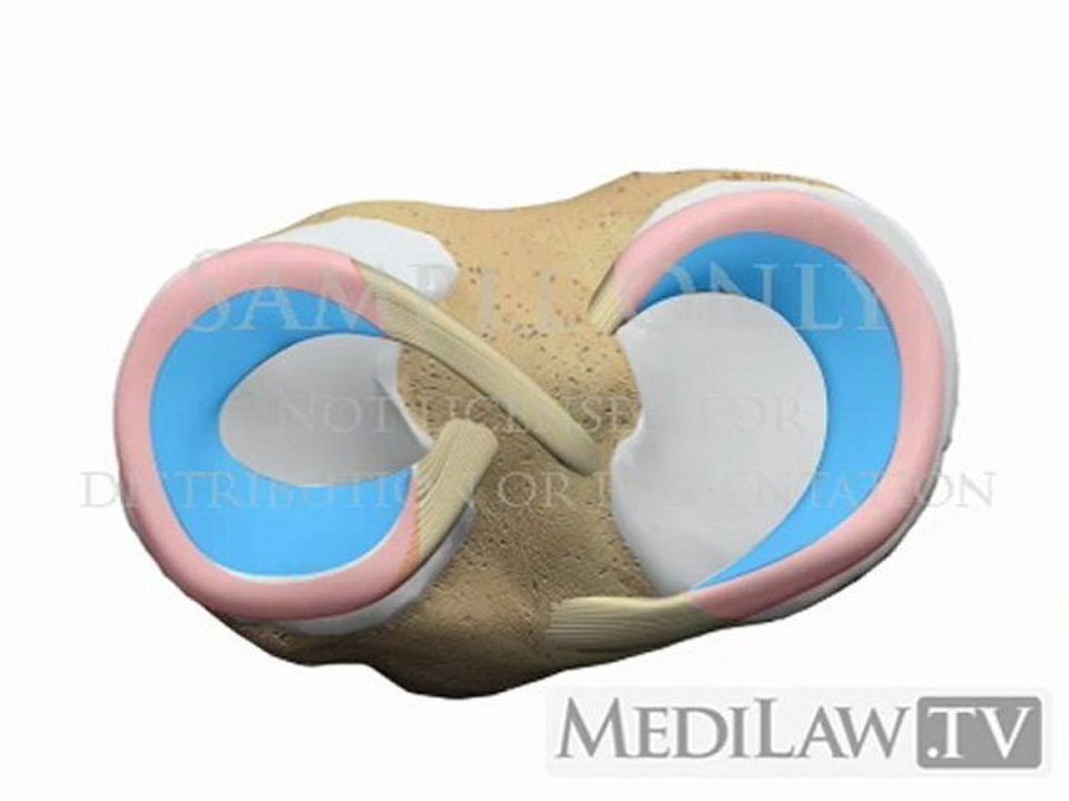 Knee Meniscal Meniscus Longitudinal Vertical Bucket Handle Tear medical ...