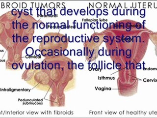 Fibroid Tumors