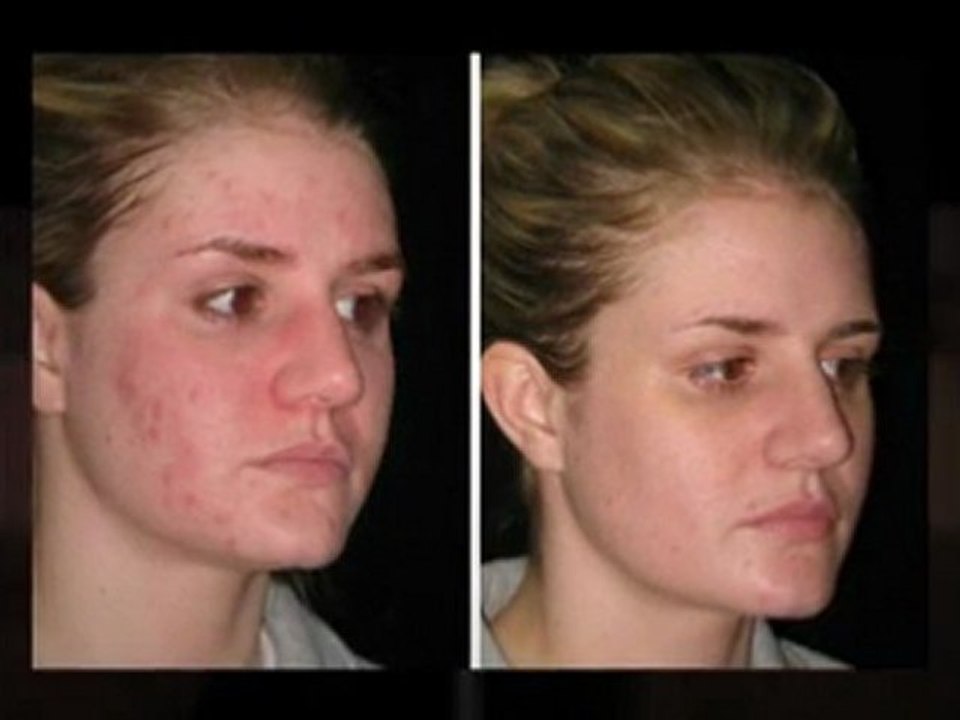 How To Get A Clear Face
