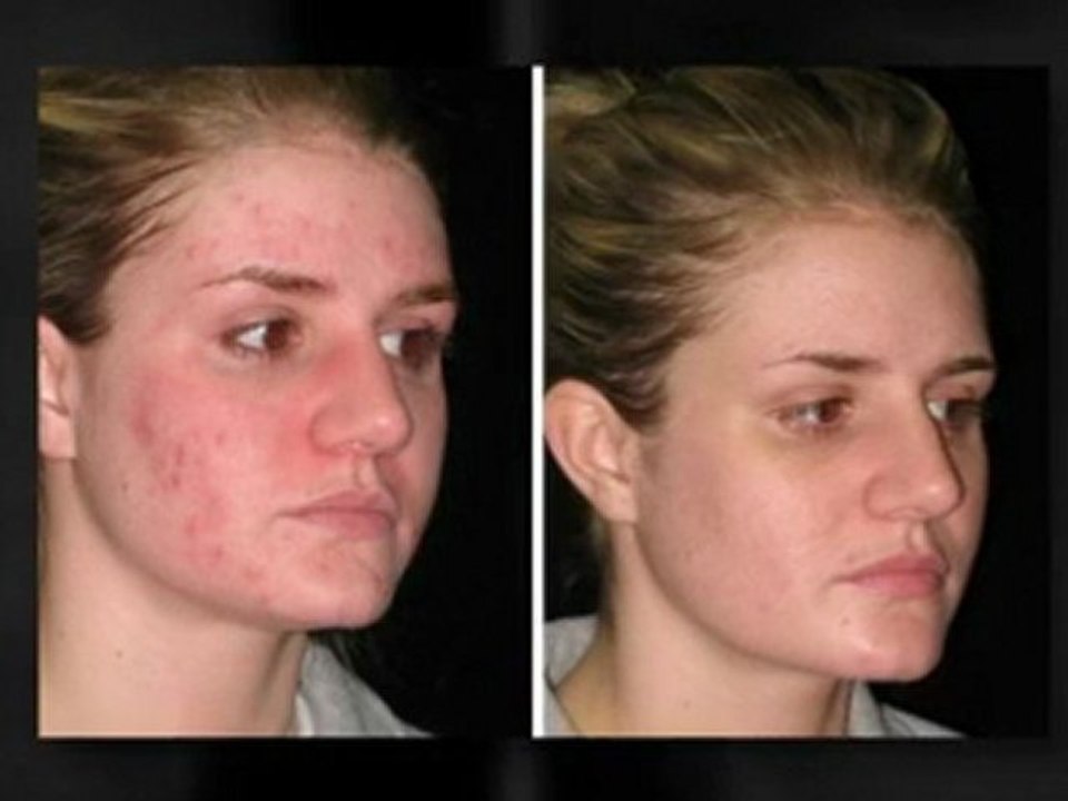 Home Remedies For Zits