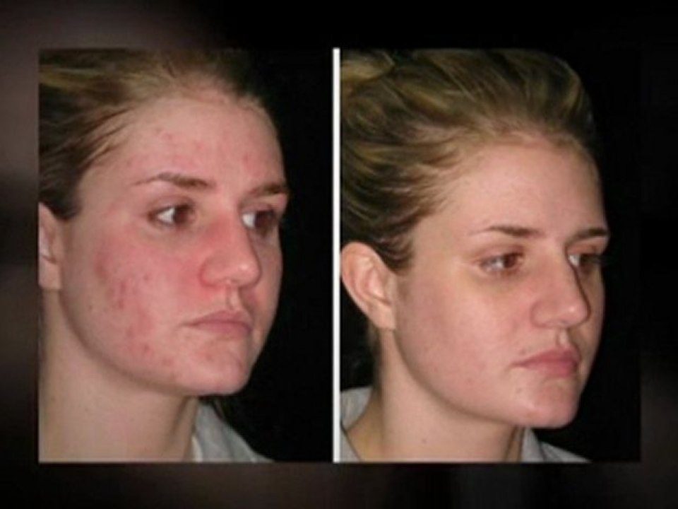 Testimonials On Home Remedies For Zits