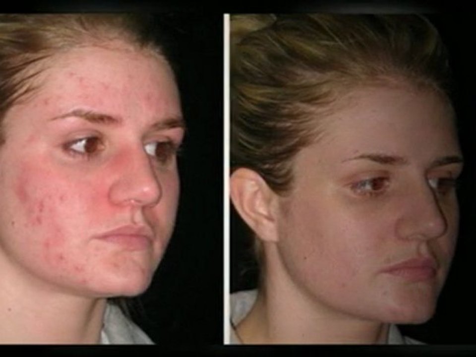 How To Get A Clear Face - Testimonials As Proof