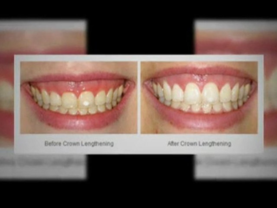 Dental Implants Seattle