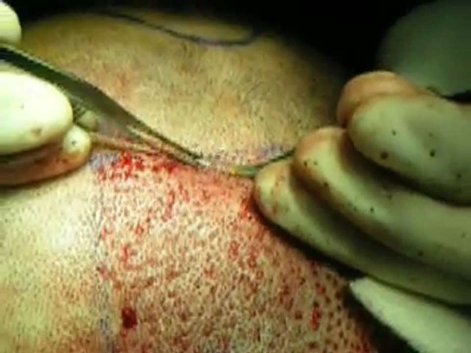 Hair Transplant | FUE hair procedure| Hair Transplant Cost  in Afghanistan