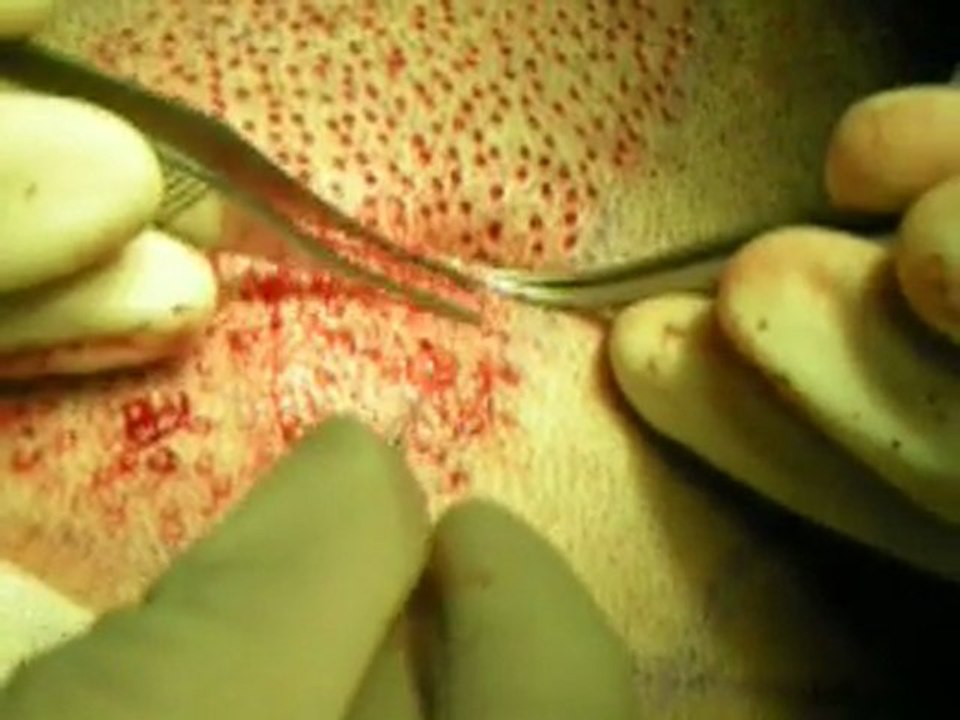 FUE hair transplant extraction in Dubai / Cheap hair transplant Dubai