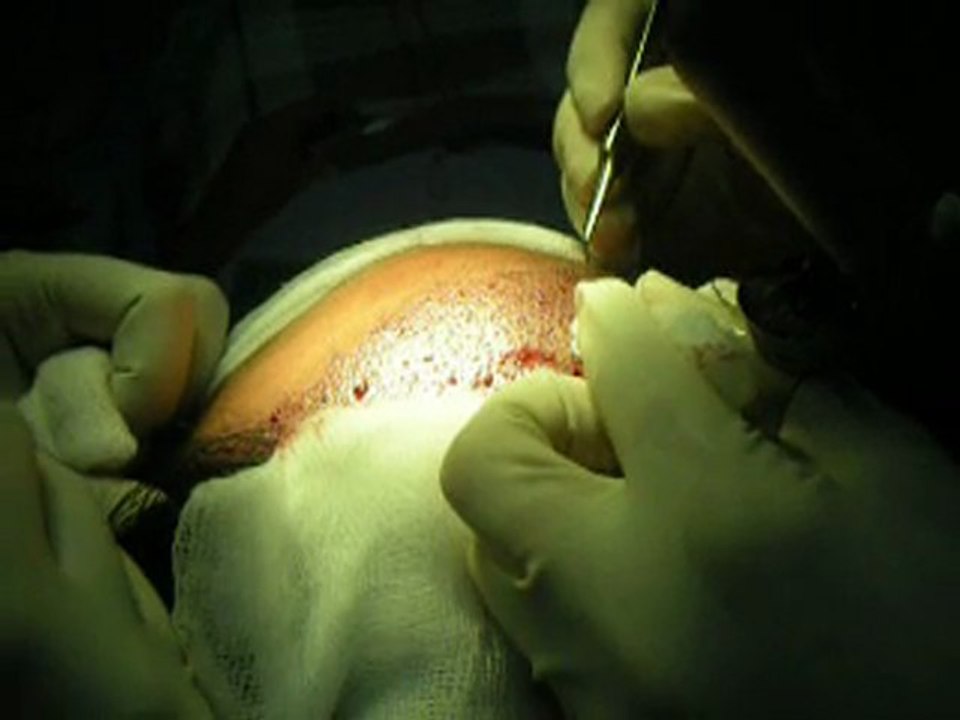 Hair Transplant Restoration Istanbul ,Ankara- Turkey