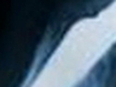 ASR Hip Recall - How Could a DePuy ASR Hip Implant Cause a Bone Fracture?