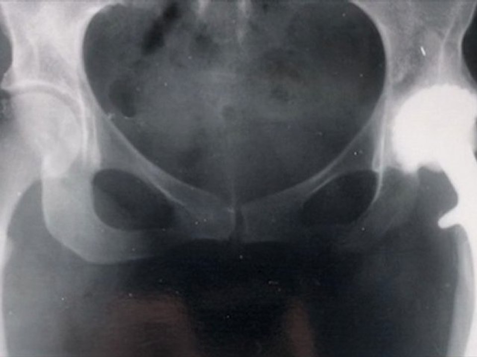 Implants du futur (extrait)