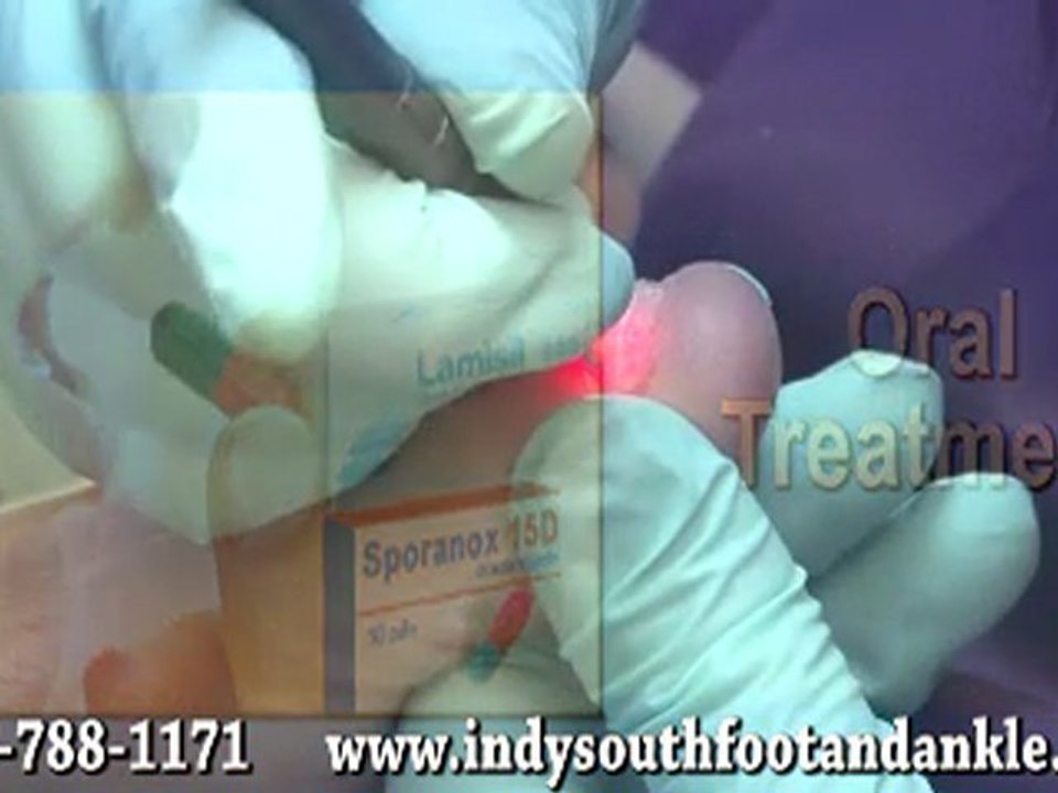 Laser Treatment for Fungal Toenails - Podiatrist Indianapolis and Franklin, IN