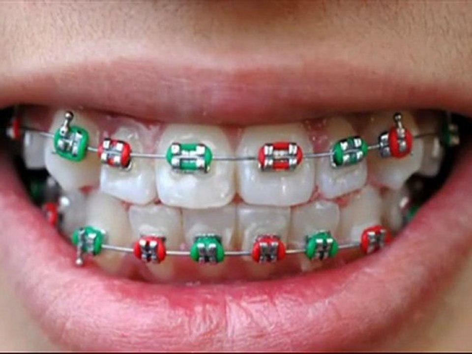 Pose Appareil Dentaire - les différentes étapes