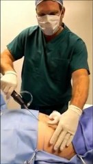 Tickle Lipo San Diego Dr. Reagan