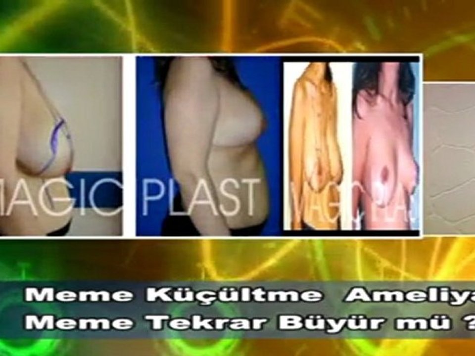 Dr. Güner Uysal Meme Küçültme Ameliyatından Sonra Meme Tekrar Büyürmü