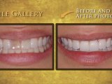 Cosmetic Dentistry Highland, Utah - Mont Blanc Center for Dentistry