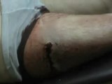 فري برس   حمص البياضة اسعاف جريح على مشفى ميداني 3 12 2011