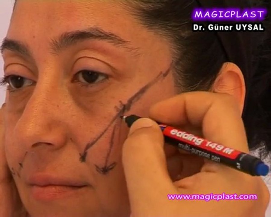 Op. Dr. Güner Uysal Yüz Estetiği Öncesi Planlama Sürecini Anlatıyor