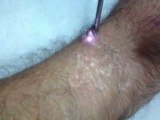 enlever les tatouages du bras par le laser