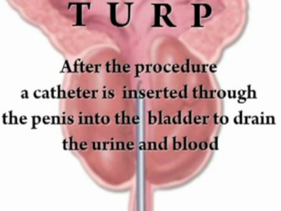 Enlarged Prostate Treatment NJ