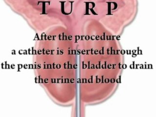 Enlarged Prostate Treatment NJ