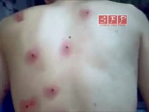 دوما إصابات المتظاهرين في جمعة اسرى الحرية 17-5-2011