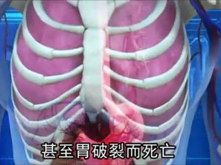 Woman nearly dies after stomach stretched to five times its normal size