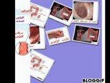 cancer colorectal.-Version en Arabe-Dr AMINE A.-Casblanca-Maroc