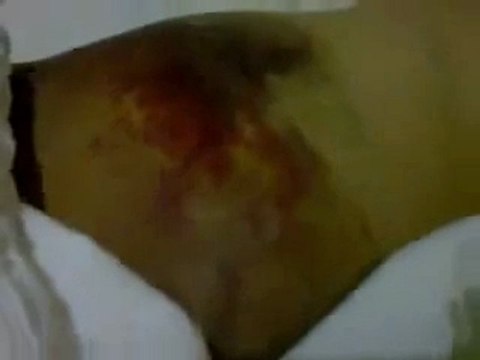 فري برس آثار التعذيب على أحد المعتقلين الذين خرجوا من الاعتقال من فرع الأمن العسكري