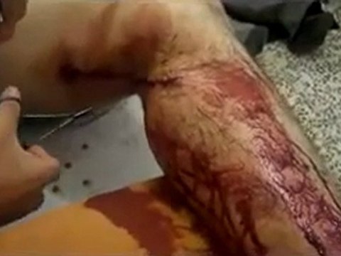 فري برس حمص البياضة من استطعنا ان نصوره من الجرحى 27 11 2011