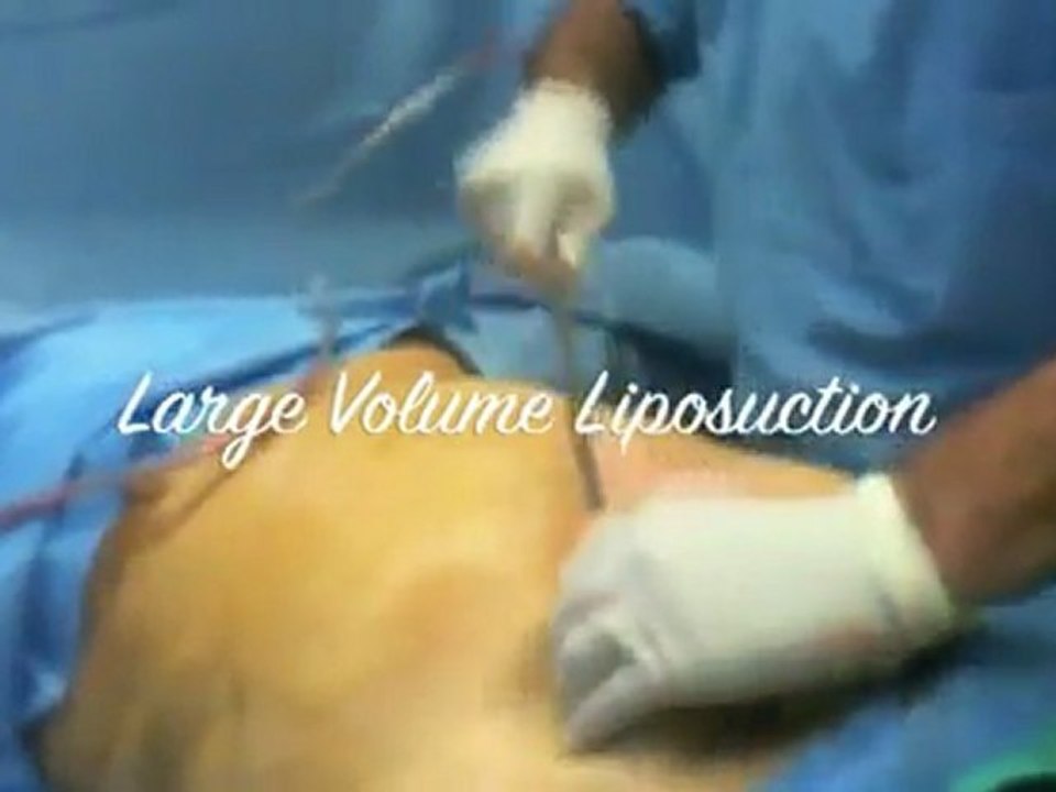 Liposuction Hawaii video of live person