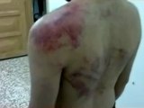 فري برس   حمص البياضة اثار تعذيب الشبيحة على ااحد الاهالي 25 12 2011