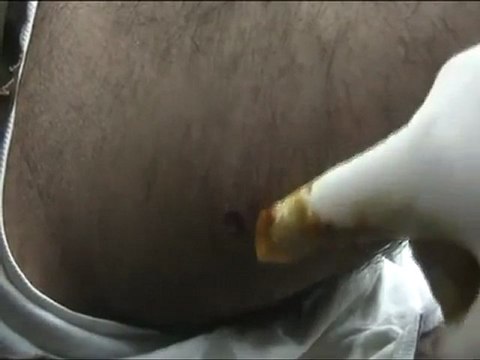 فري برس حمص باباعمرو جريح اثناء خروج اللجنة 27 12 2011