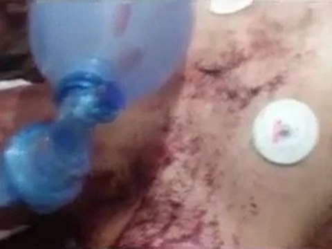 فري برس حمص حي الخالدية جريح بحالة خطرة جدا جراء استهداف الحي بعد عصر اليوم من قبل عناصر الأمن والشبيحة 10 1 2012