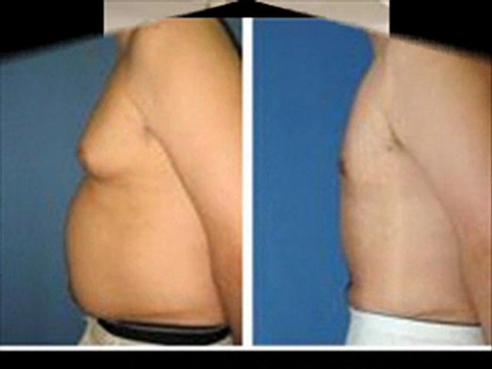 AESTHETIC LIPOSUCTION SURGERY