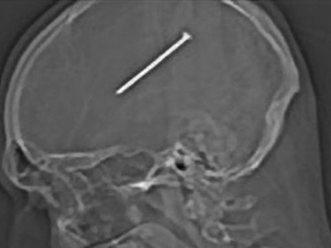 Il frôle la mort à cause d'une machine à clous.