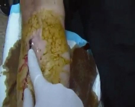 فري برس باباعمرو جريح اثر طلقة قناصة 18 11 2011