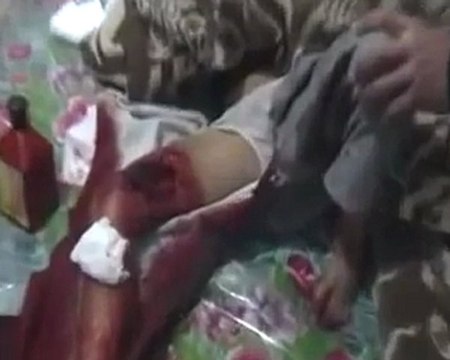 فري برس حمص كرم الزيتون إصابة طفل في منطقة الفخذ بسبب إطلاق النار العشوائي من حواجز الامن 30 11 2011