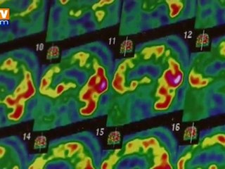 Alzheimer : une protéine pour dépister et lutter contre la maladie