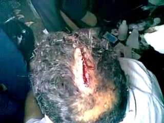 فري برس   حوران الحارّة إصابة في الرأس برصاص الجيش الأسدي 1 1 2012